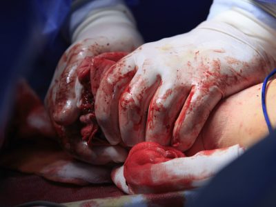 Stop the Bleeding 2